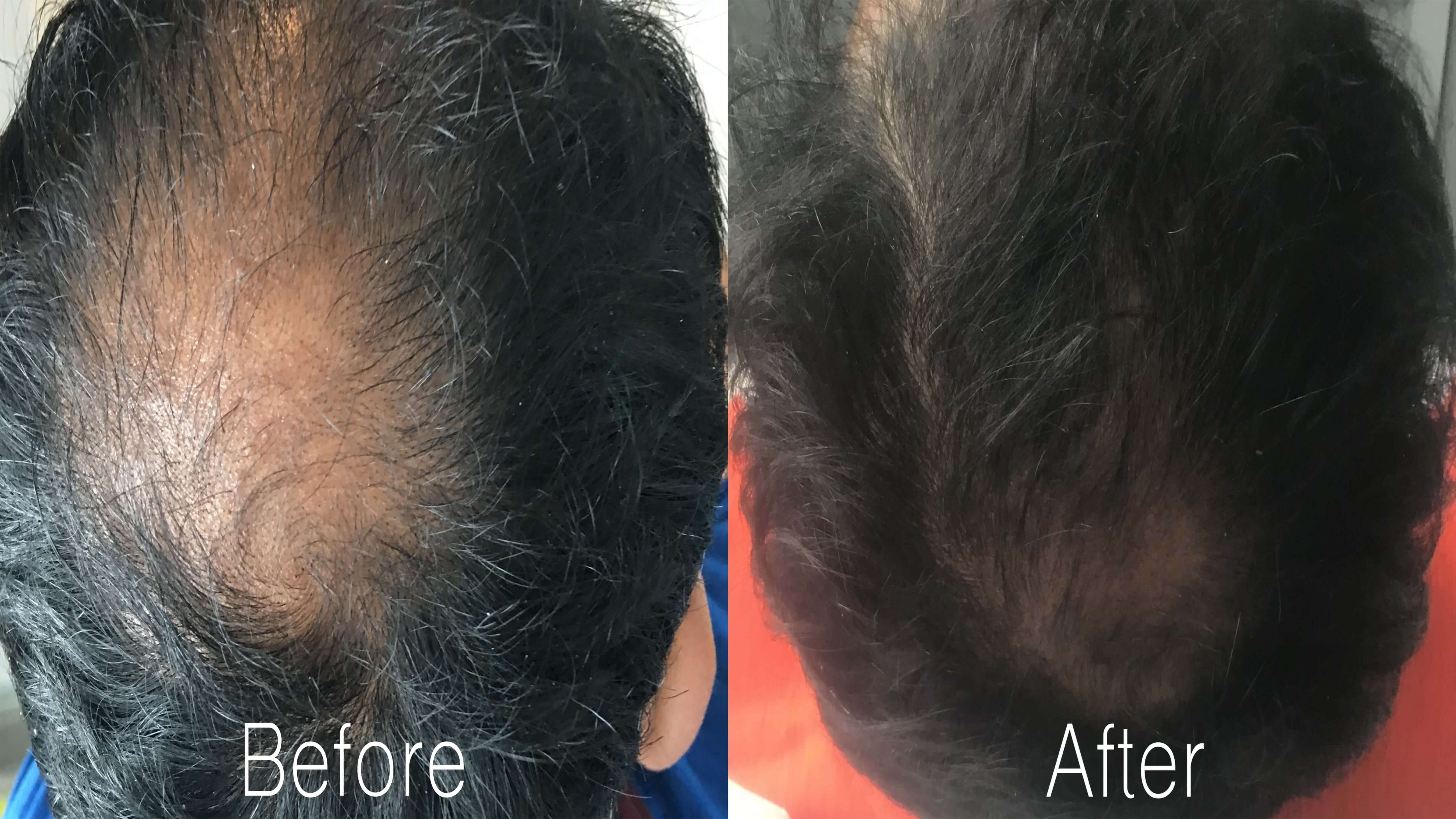 Regrow Your Own Hair Using Microneedling With PRP and RF